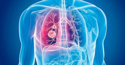 Google puede detectar el cáncer de pulmón en un 99% de los casos