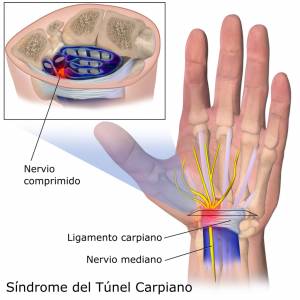 Síndrome del túnel carpiano - Qué es y cómo prevenirlo