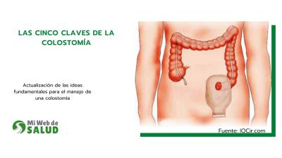 Las Cinco Claves De La Colostomía
