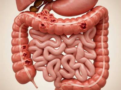Enfermedad de Crohn: causas, síntomas y tratamiento