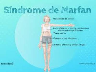 Síndrome de Marfan