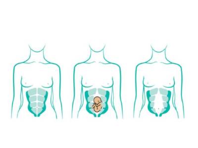 Diástasis después del embarazo: tratamientos| Mujer y MADRE hoy